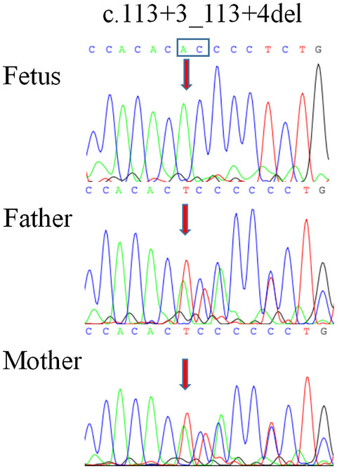 Expanding the phenotype of STRA6-related disorder to include left ventricular non-compaction