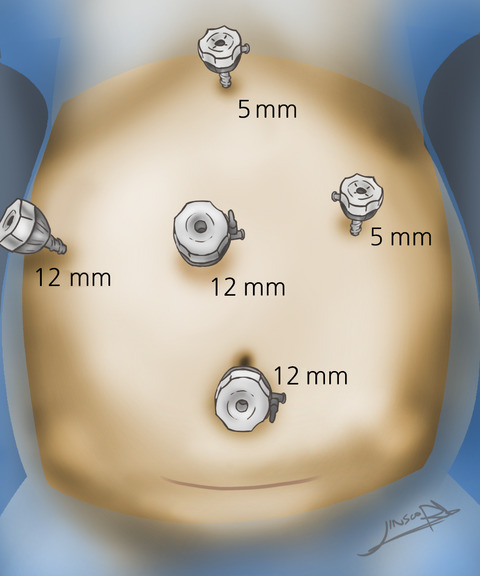 Feasibility of total laparoscopic living donor right hepatectomy compared with open surgery: comprehensive review of 100 cases of the initial stage