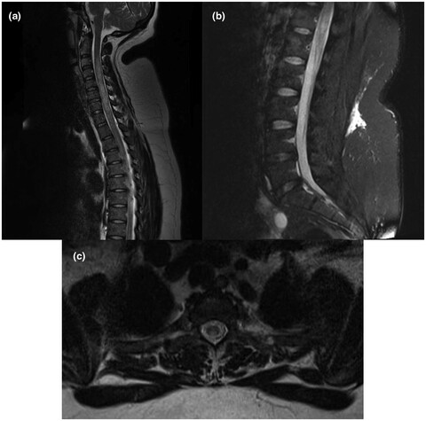 Transverse myelitis and coronavirus disease 2019 vaccine: A temporal association