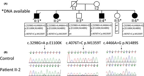 Novel compound heterozygous mutation in SACS gene leads to a milder autosomal recessive spastic ataxia of Charlevoix-Saguenay, ARSACS, in a Finnish family