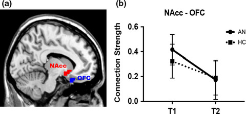 Resting-state connectivity within and across neural circuits in anorexia nervosa