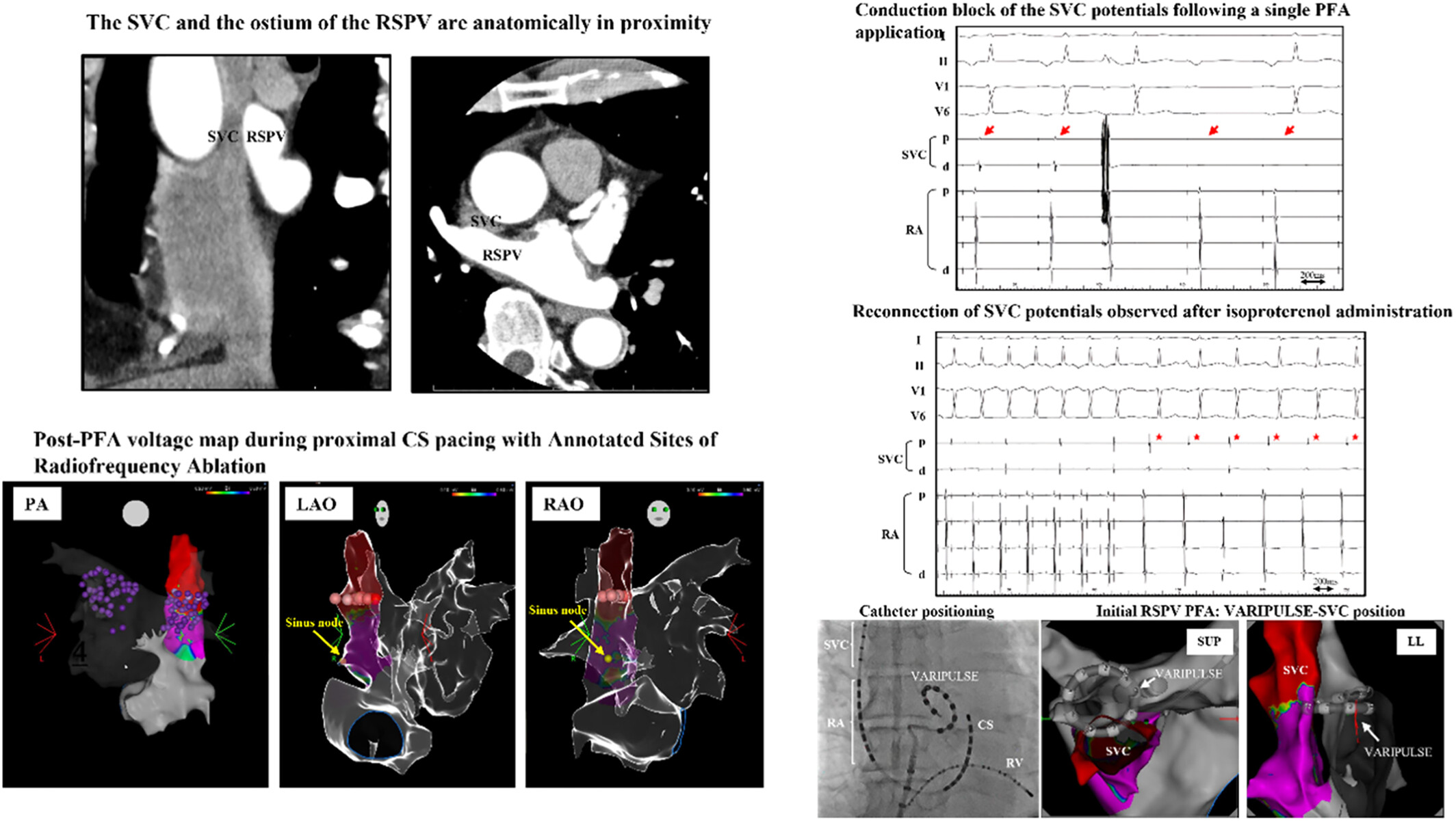 Transient conduction block of the superior vena cava following pulsed field ablation of the right superior pulmonary vein
