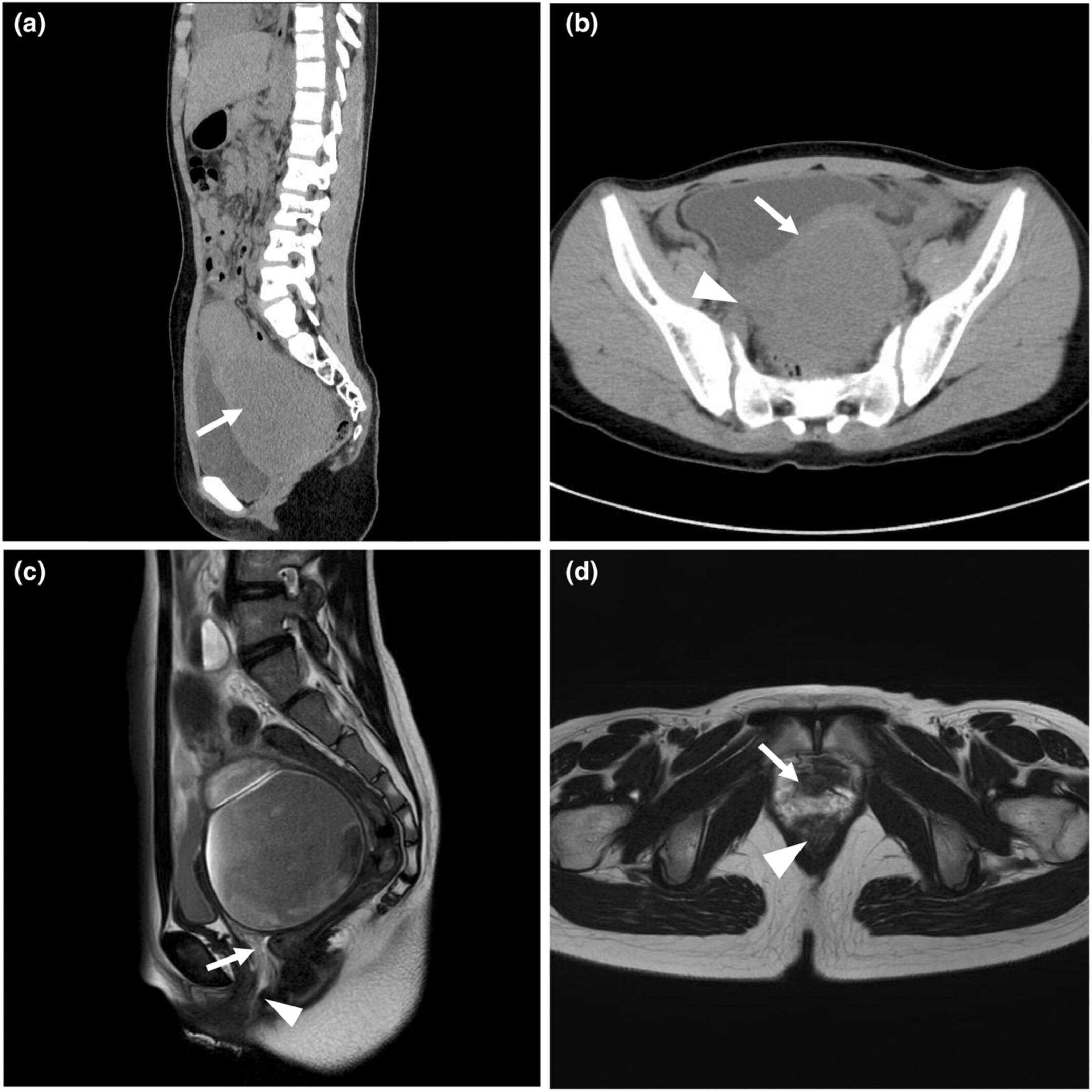 Hematocolpos due to lower vaginal agenesis in an adolescent girl