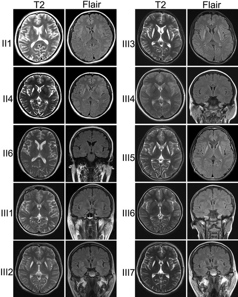 Bilateral striatal necrosis due to homoplasmic mitochondrial 3697G>A mutation presents with incomplete penetrance and sex bias