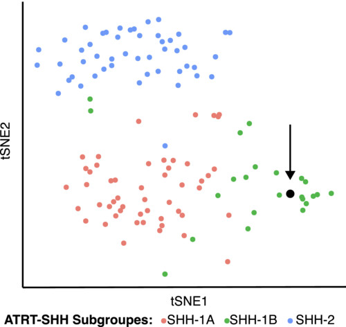 Diffuse infiltrating tumour with the molecular profile of an atypical teratoid rhabdoid tumour (AT/RT SHH-1B) in an adult patient