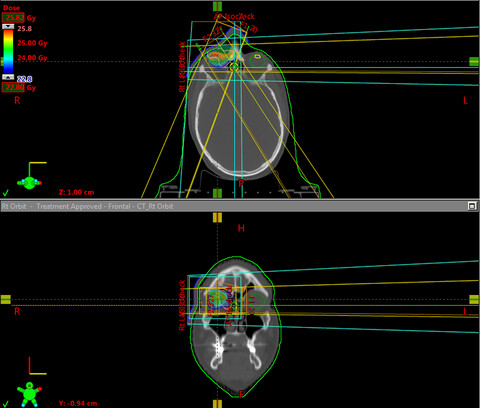 Examining the utility of lower dose radiotherapy for localised primary ocular adnexal MALT lymphoma