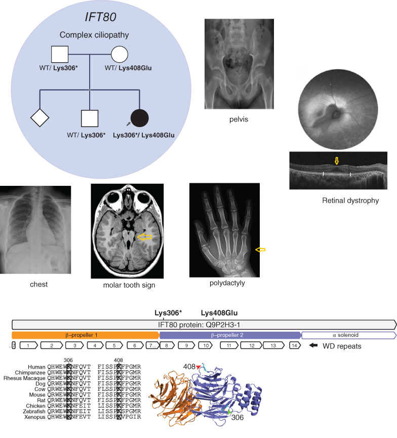 IFT80 mutations cause a novel complex ciliopathy phenotype with retinal degeneration