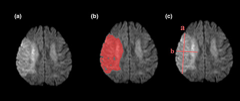 Two simple and rapid methods based on maximum diameter accurately estimate large lesion volumes in acute stroke