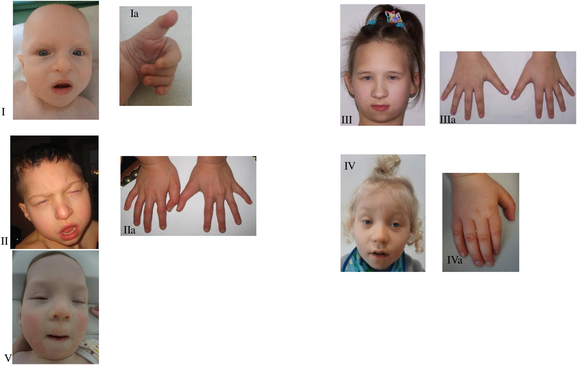 Clinical heterogeneity of polish patients with KAT6B–related disorder