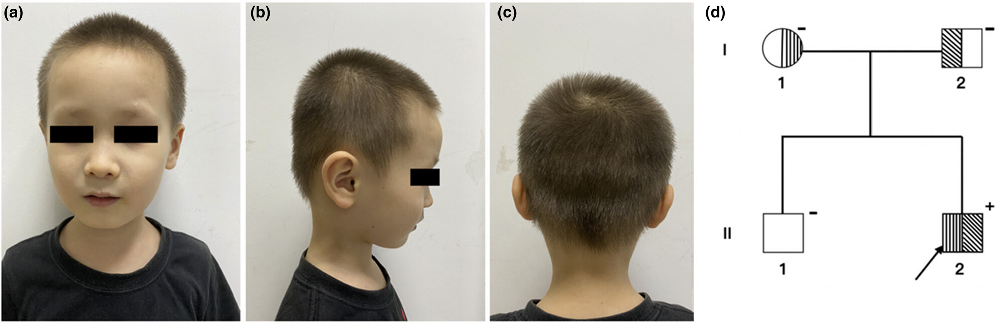 Oculocutaneous albinism type 4: Novel compound heterozygous mutations in the SLC45A2 gene in a Chinese case