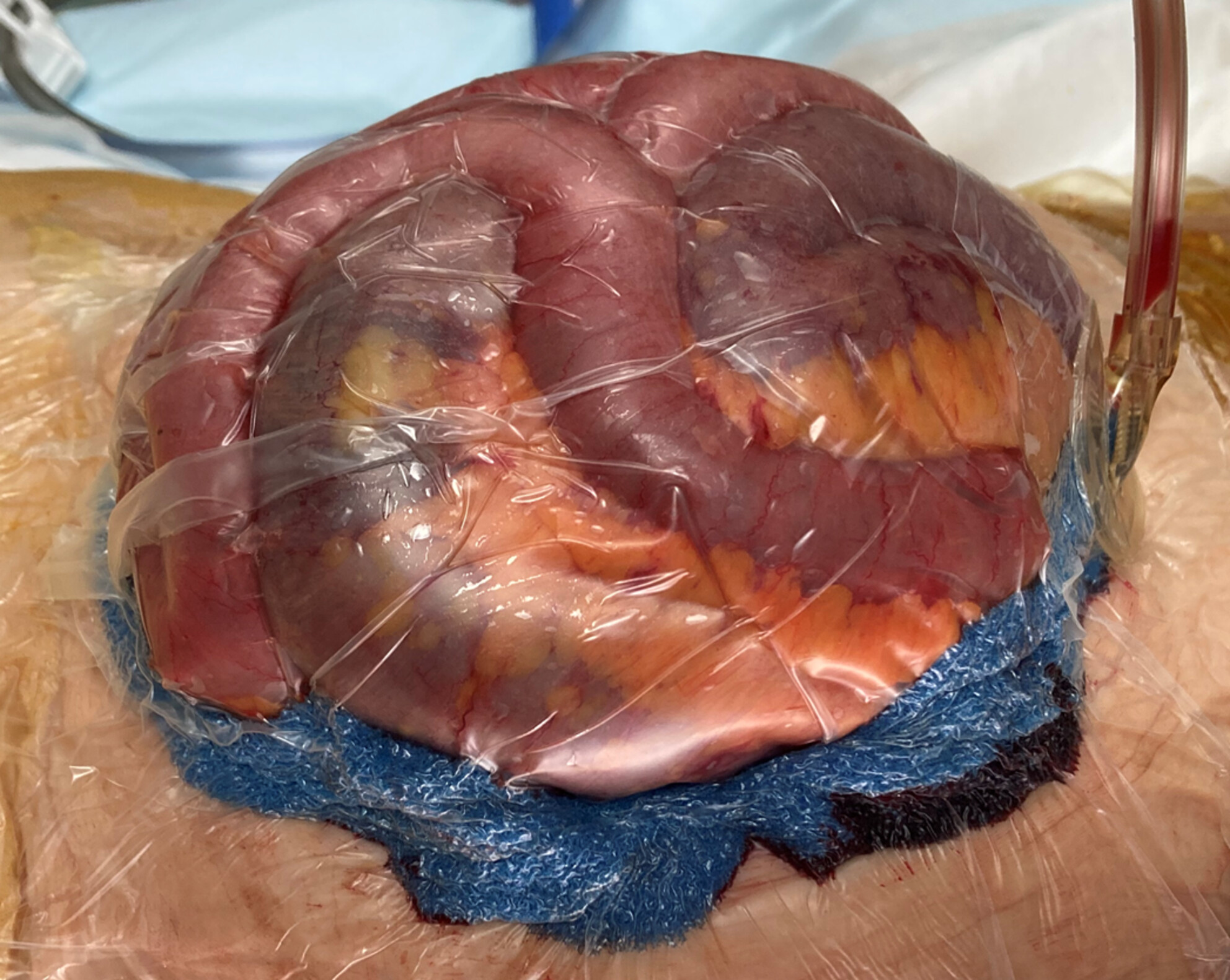 Visible negative pressure wound therapy for open abdominal management: A single-center retrospective study