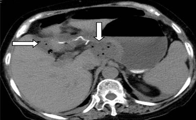 Predictive factors and diagnostic significance of CT findings for anastomotic leak after gastric cancer surgery: A retrospective analysis