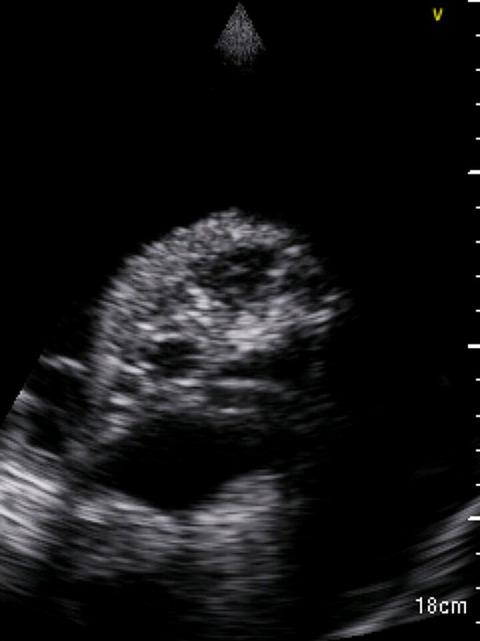 Early detection of pleuro-pulmonary tuberculosis by bedside lung ultrasound: A case report and review of literature