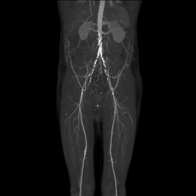 Reconstruction of the aorto-iliac segment in occlusive disease using the AFX unibody graft