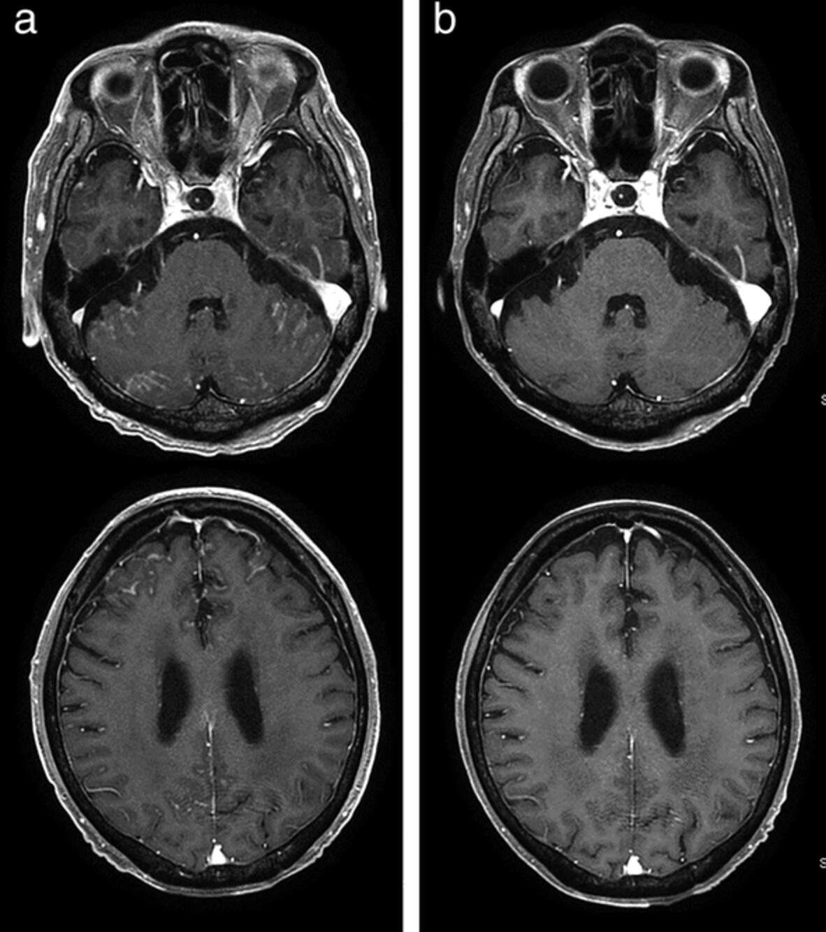 Remarkable response to dacomitinib in a patient with leptomeningeal carcinomatosis due to EGFR-mutant non-small cell lung cancer
