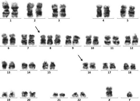 Therapy-related acute myeloid leukemia after chemotherapy in extensive disease-small cell lung cancer