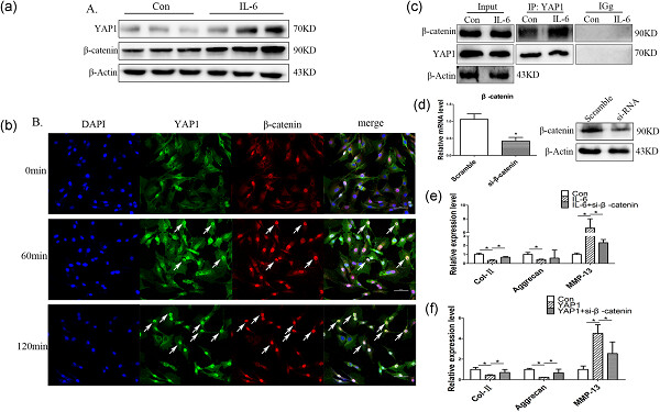 IL-6/YAP1/β-catenin signaling is involved in intervertebral disc degeneration