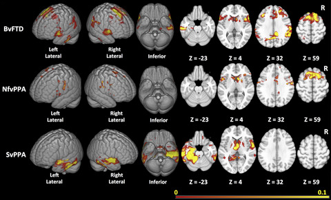Data-driven regions of interest for longitudinal change in three variants of frontotemporal lobar degeneration