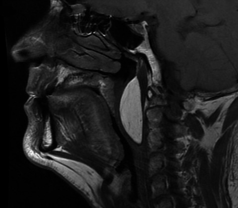 Sleep apnea: Do not forget to inspect the throat!