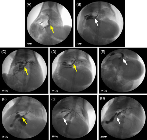 Acute and subacute effects of irreversible electroporation on normal common bile ducts in a rabbit model