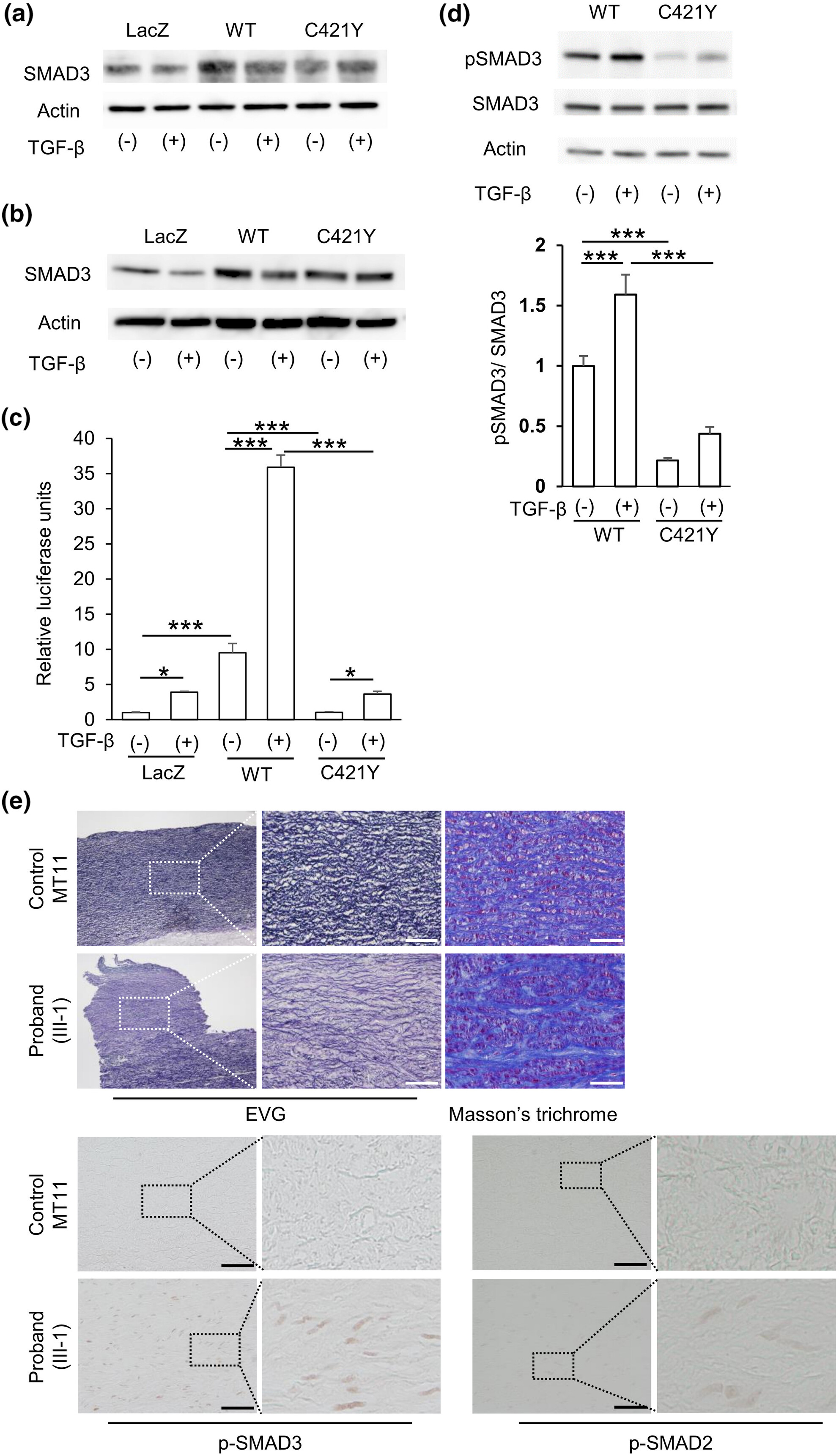 A novel pathogenic variant located just upstream of the C-terminal Ser423-X-Ser425 phosphorylation motif in SMAD3 causing Loeys–Dietz syndrome