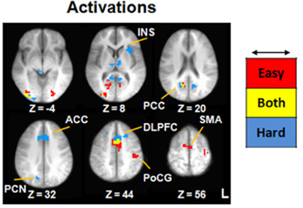 Dissociable brain signatures of choice conflict and immediate reward preferences in alcohol use disorders