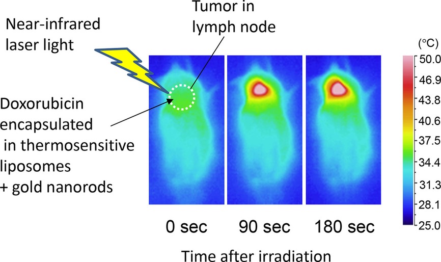 Treatment of tumor in lymph nodes using near-infrared laser light-activated thermosensitive liposome-encapsulated doxorubicin and gold nanorods
