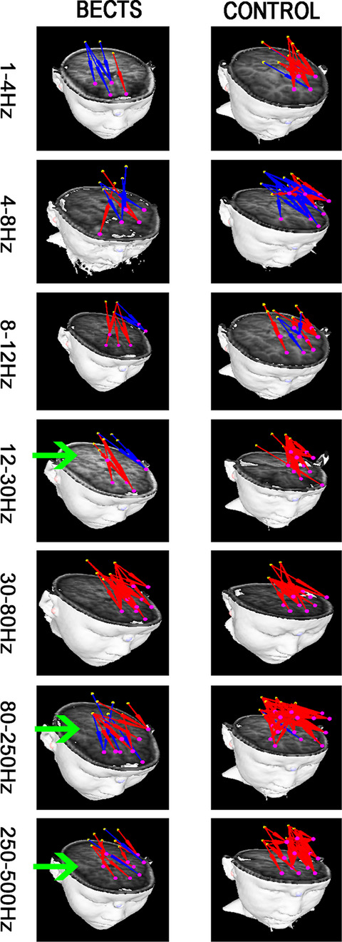 The relationship between epilepsy and cognitive function in benign childhood epilepsy with centrotemporal spikes