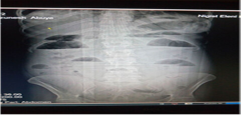 Appendico-ileal knotting causing small bowel obstruction: A case report