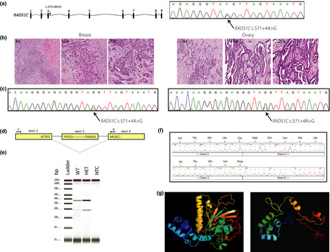 A dominant RAD51C pathogenic splicing variant predisposes to breast and ovarian cancer in the Newfoundland population due to founder effect