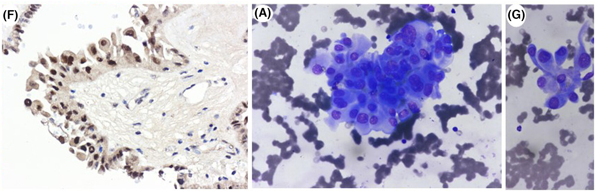 Hobnail subtype of papillary carcinoma of the thyroid—a rare case with uncommon features