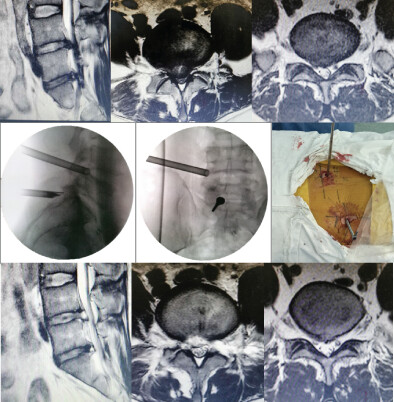 Percutaneous Endoscopic Lumbar Discectomy via Transforaminal Approach Combined with Interlaminar Approach for L4/5 and L5/S1 Two-Level Disc Herniation
