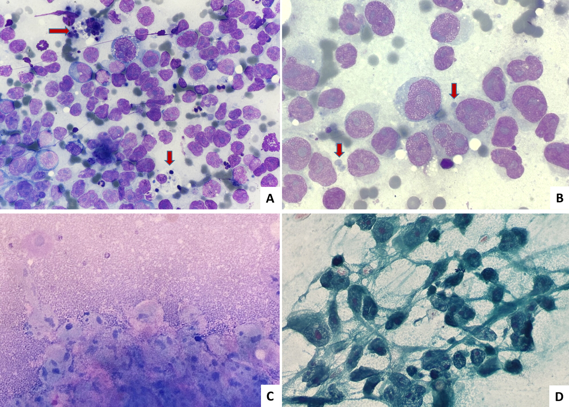 Cytology of an Axillary Mass: A Rare Case