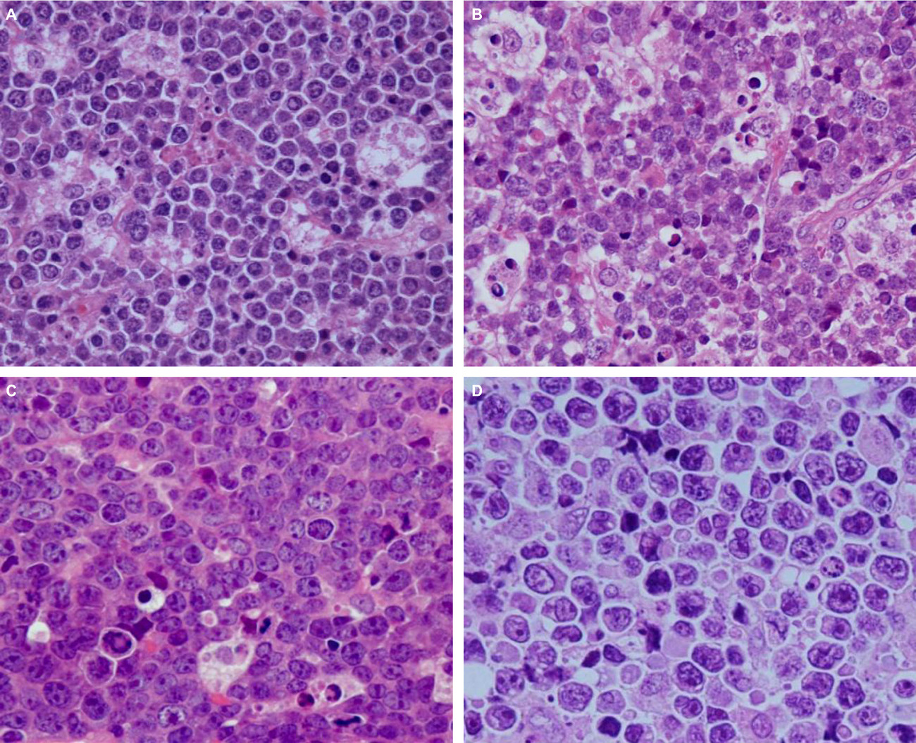 Classification of AIDS-related lymphoma cases between 1987 and 2012 in Japan based on the WHO classification of lymphomas, fourth edition