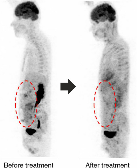 Response to pazopanib-based combination regimen in a case of FGFR3 amplified gastric adenocarcinoma