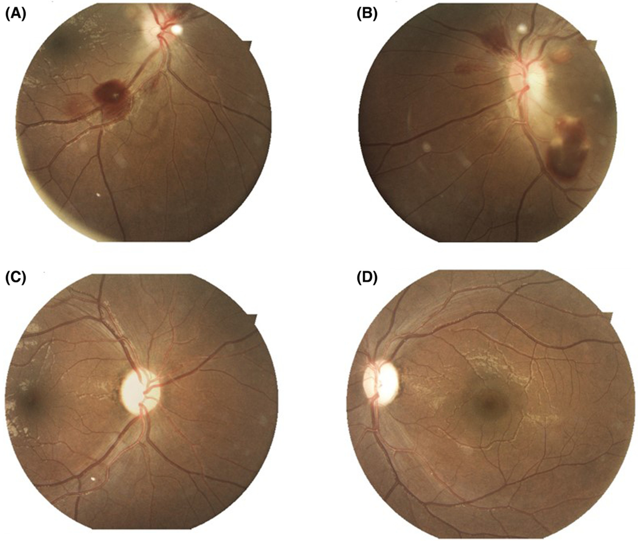 Wernicke's encephalopathy: Is visual loss a red herring?