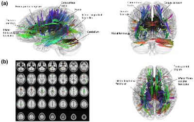 Correlation of diffusion tensor tractography with obstructive sleep apnea severity