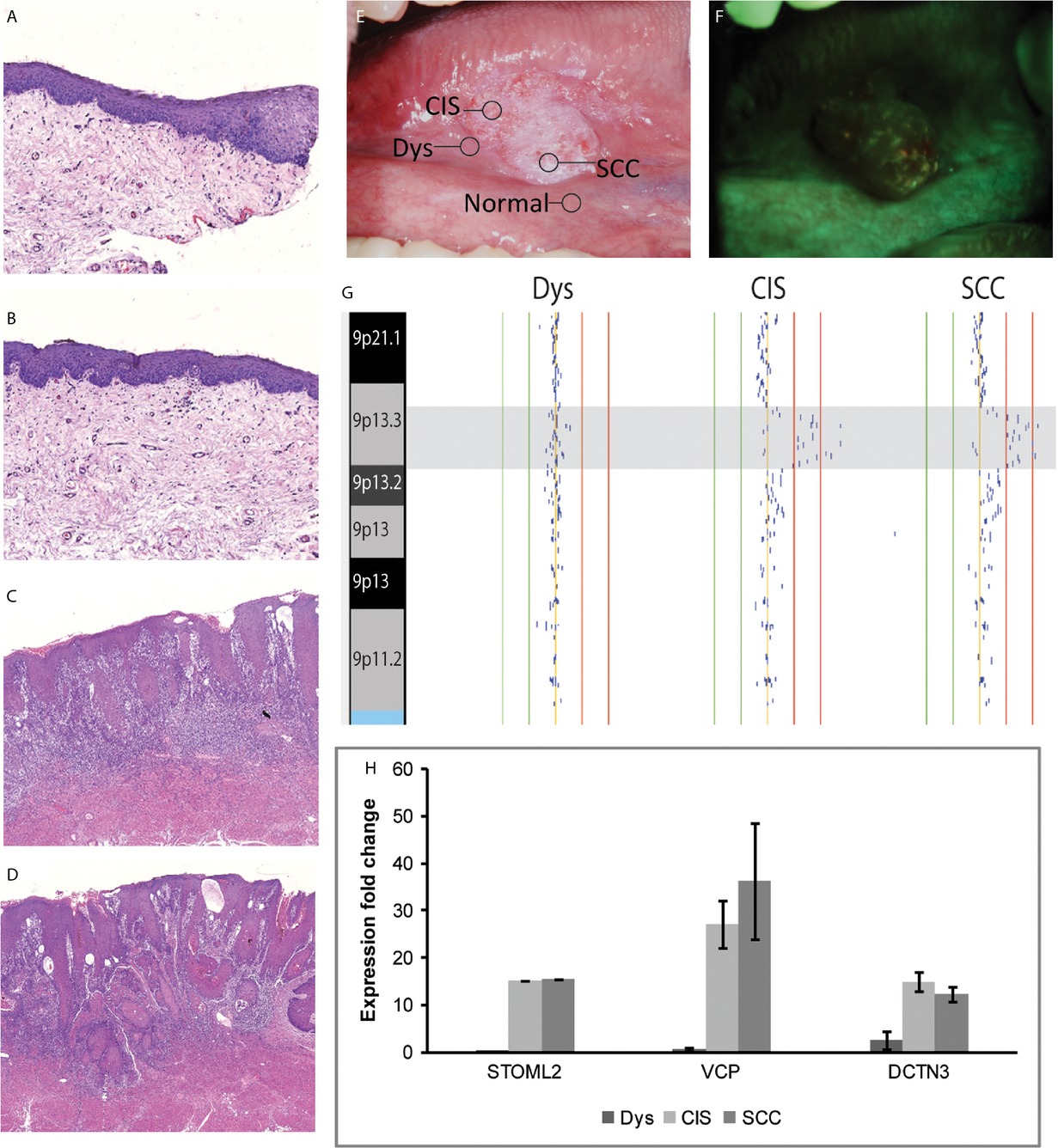 Recurring DNA copy number gain at chromosome 9p13 plays a role in the activation of multiple candidate oncogenes in progressing oral premalignant lesions