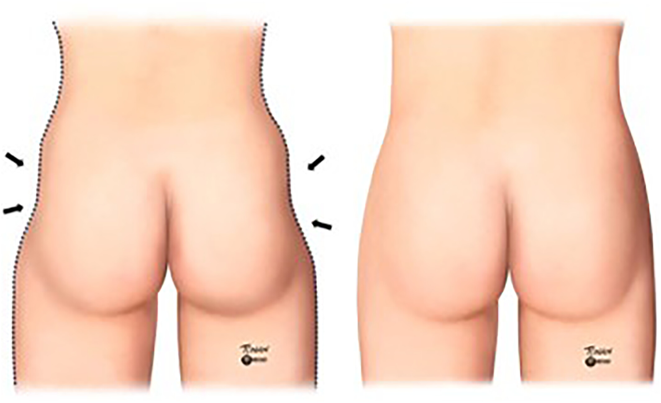 Hip dips technique: Filling lateral depressions with hyaluronic acid of large particles