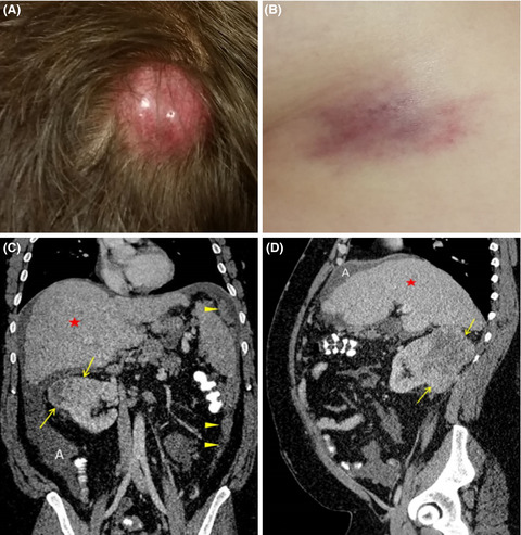 Cutaneous metastasis of renal cell carcinoma: Fine needle aspiration provides rapid diagnosis
