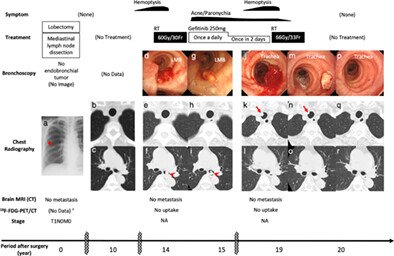 Lung adenocarcinoma with repetitive endotracheal/endobronchial metastasis 20 years after surgery: A case report