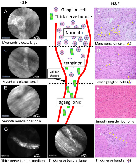 Visualization of the human enteric nervous system by confocal laser endomicroscopy in Hirschsprung's disease: An alternative to intraoperative histopathological diagnosis?