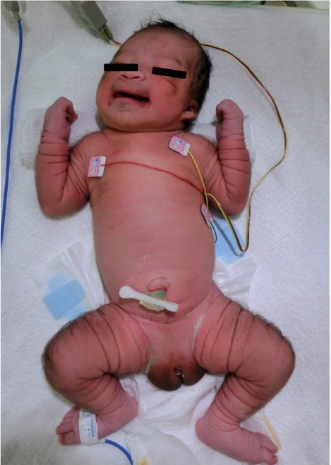 A case of Barber-Say syndrome in a male Japanese newborn