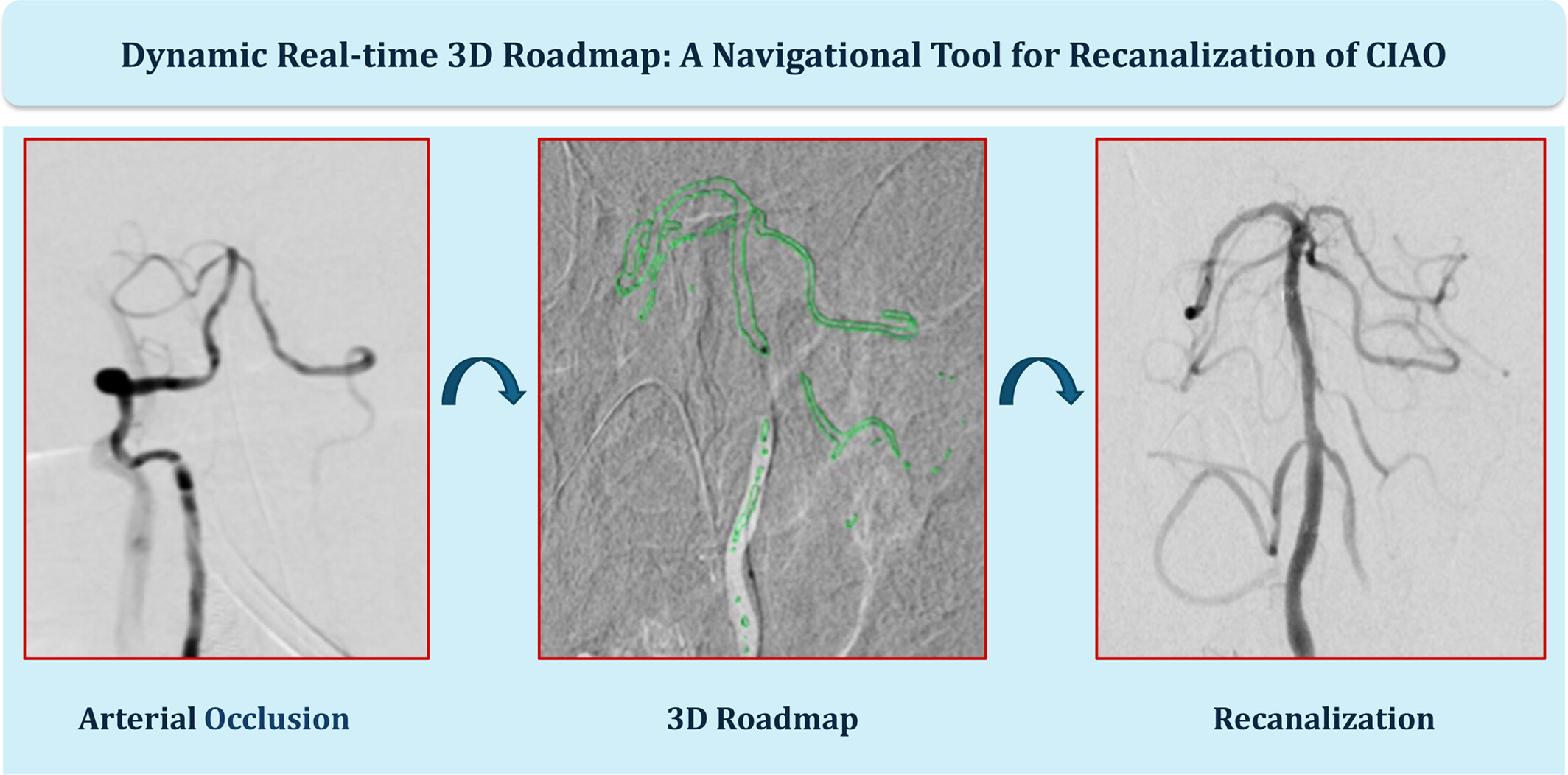 Dynamic real-time 3D roadmap: A navigational tool for endovascular recanalization in chronic intracranial arterial occlusion