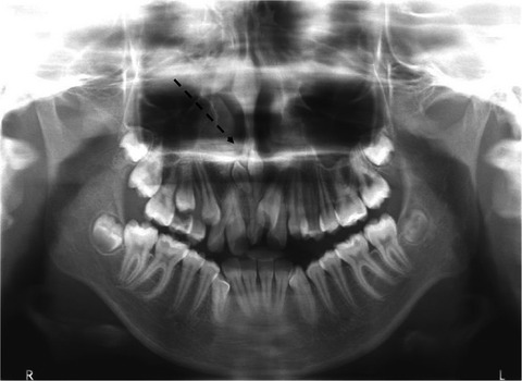 Rotated mesiodens in children. An immediate surgical removal or active monitoring?