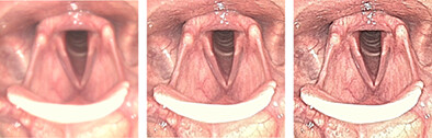 Edge Enhancement Optimization in Flexible Endoscopic Images to the Perception of Ear, Nose and Throat Professionals