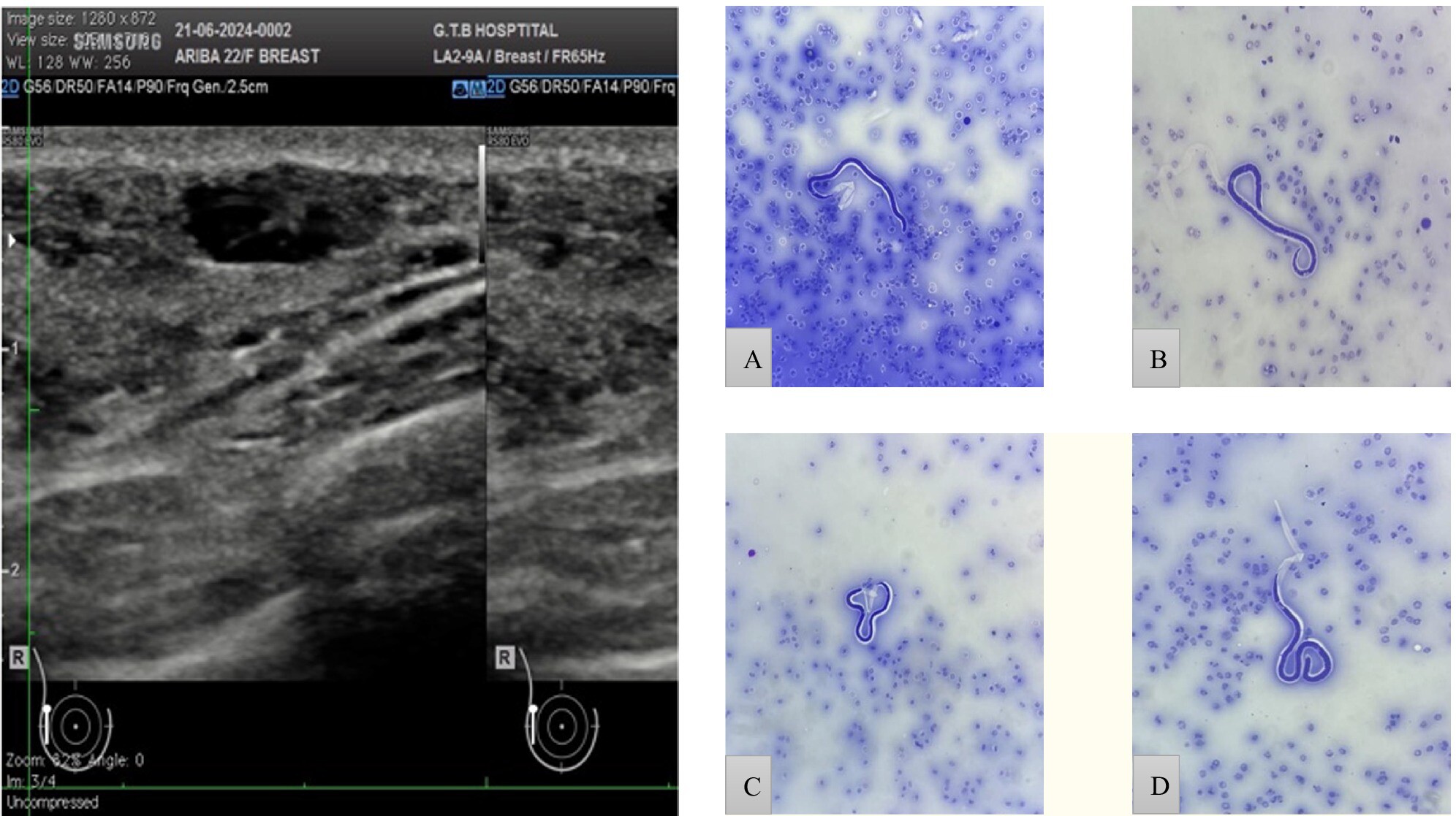 Breast Filariasis—Diagnosed by Fine Needle Aspiration Cytology: A Rare Case Report
