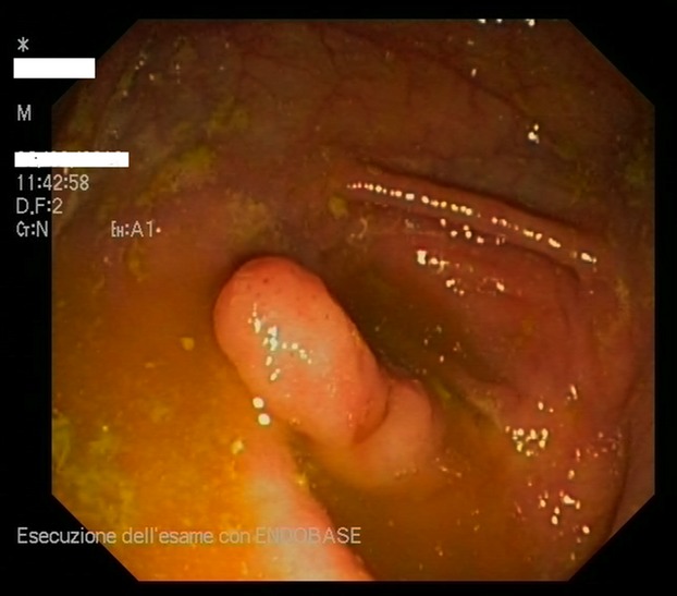 Recurrent abdominal pain in 52-year-old male