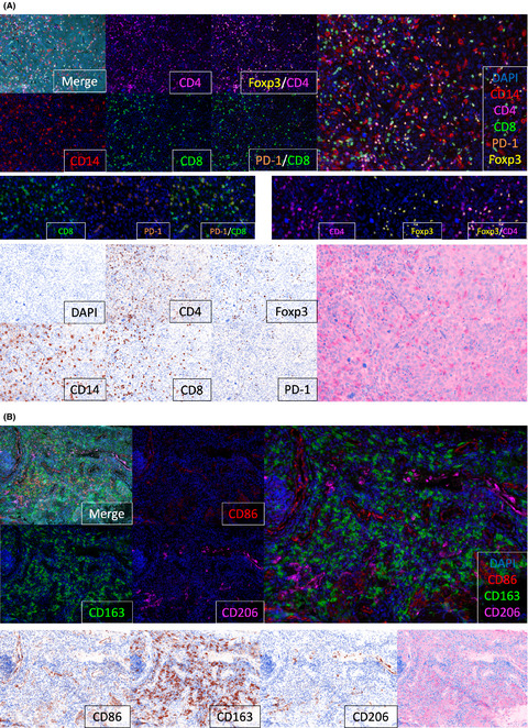 Tumor-infiltrating M2 macrophage in pretreatment biopsy sample predicts response to chemotherapy and survival in esophageal cancer