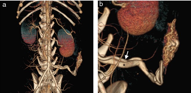Congenital subcutaneous arteriovenous malformation in a puppy: diagnosis with CT angiography
